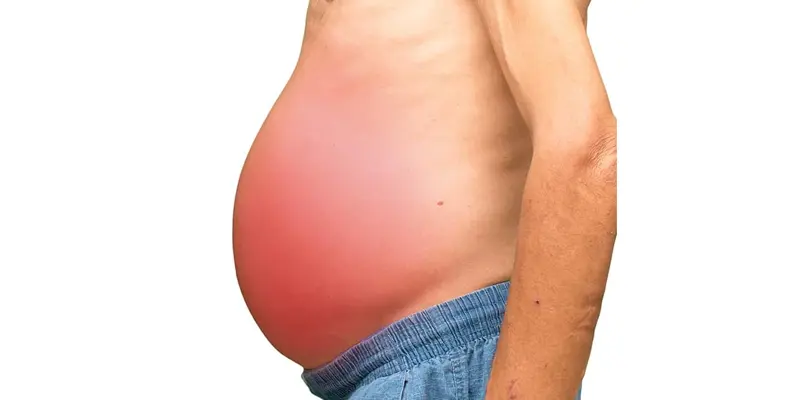 Bệnh xơ gan mất bù còn kèm theo hiện tượng cổ trướng