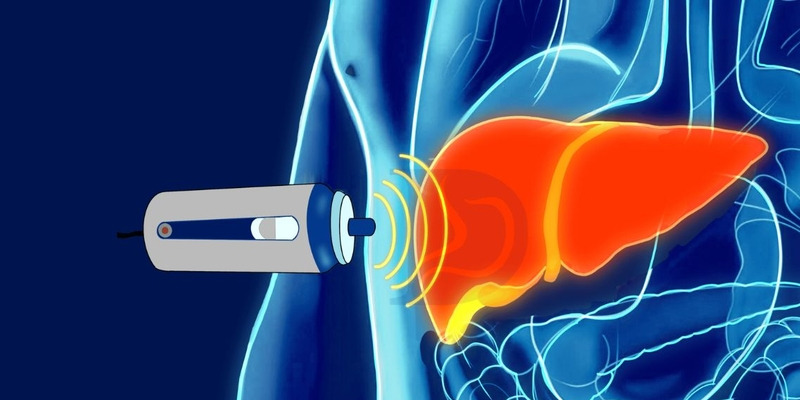 Kiểm tra mức độ xơ hóa gan bằng FibroScan