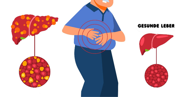 Gan nhiễm mỡ được hình thành do nhiều nguyên nhân khác nhau