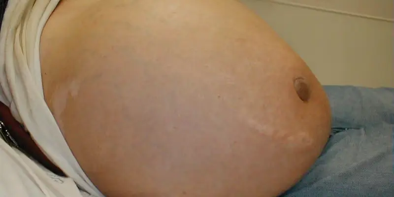 Trướng bụng là tình trạng thường xảy ra ở người bị ung thư giai đoạn cuối bị phù chân