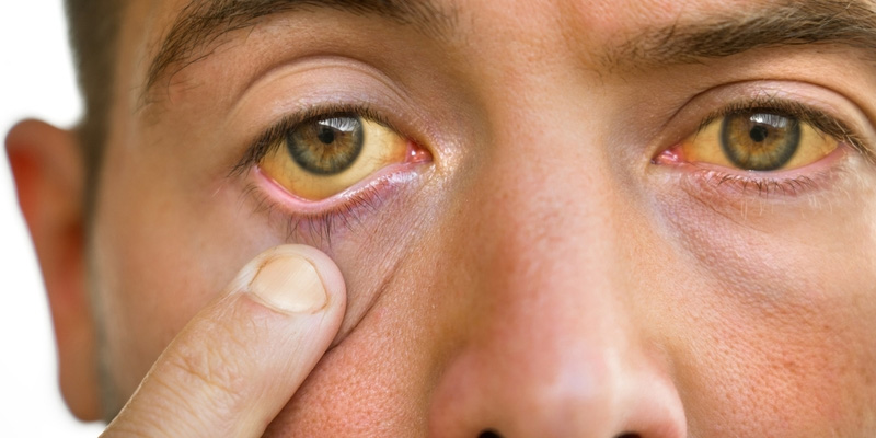 Bệnh gan sung huyết có thể gây triệu chứng vàng da, vàng mắt