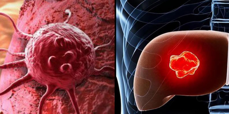 "U gan ác tính sống được bao lâu?" là thắc mắc của nhiều người bệnh