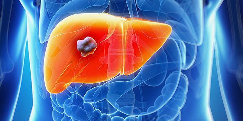 U gan lành tính thường được phát hiện khi người bệnh đi khám sức khỏe định kỳ