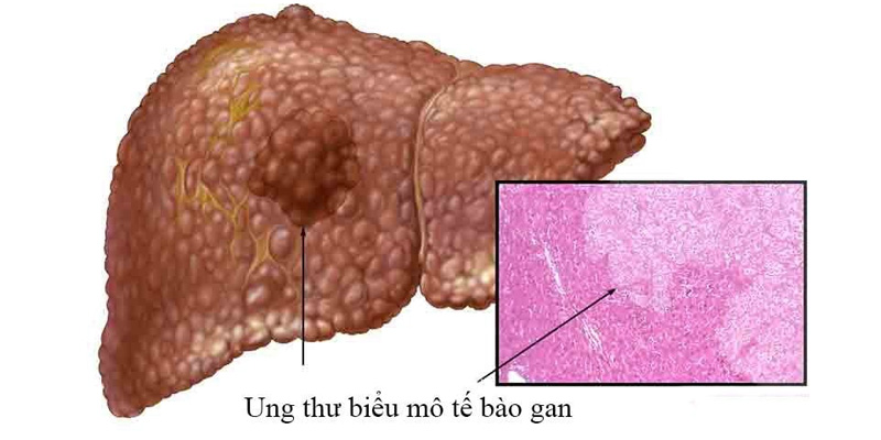 Ung thư biểu mô tế bào gan