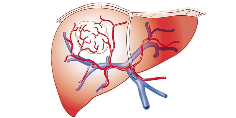 Ung thư gan là một trong những căn bệnh ác tính phổ biến và nguy hiểm hàng đầu