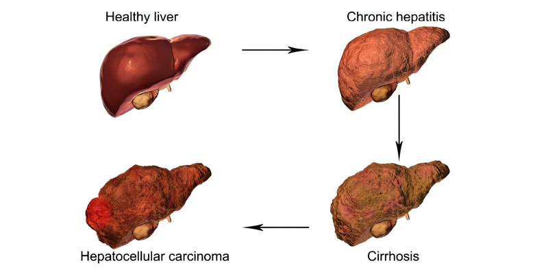Các giai đoạn phát triển thành ung thư gan