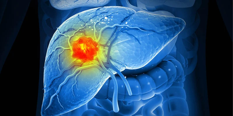 Bệnh ung thư gan có di truyền không?