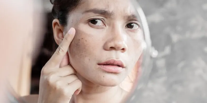 Da mặt sạm đen là một triệu chứng của ung thư gan