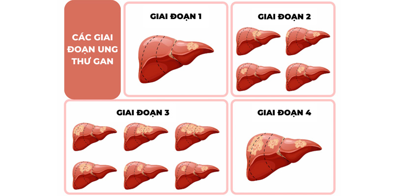 Ung thư gan giai đoạn 2 được xác định khi khối u đã lớn nhưng chưa lan rộng ngoài gan
