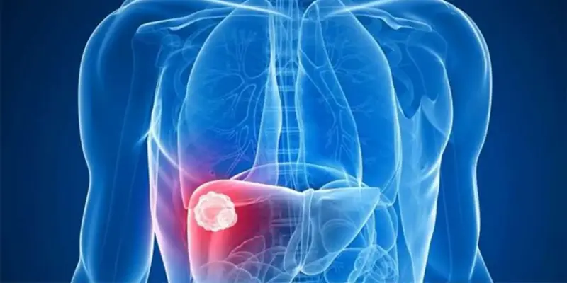 Ung thư gan giai đoạn 4 là ung thư giai đoạn cuối của bệnh