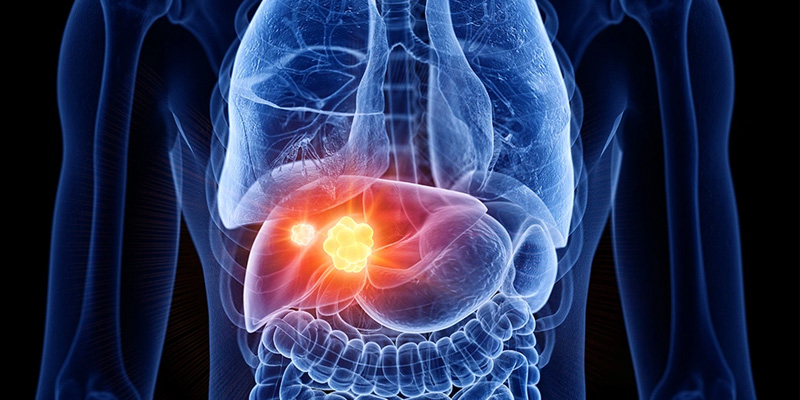 Ung thư gan giai đoạn cuối rất rõ ràng, ảnh hưởng đến chất lượng cuộc sống người bệnh.