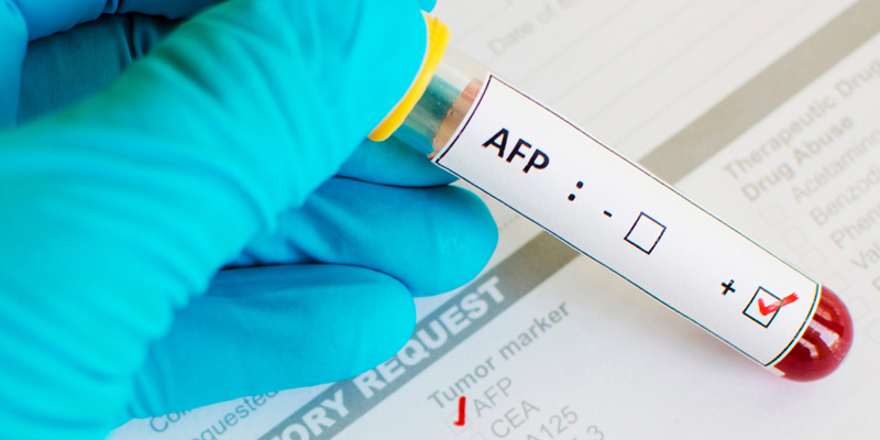 Chỉ số AFP thường tăng ở bệnh nhân ung thư gan