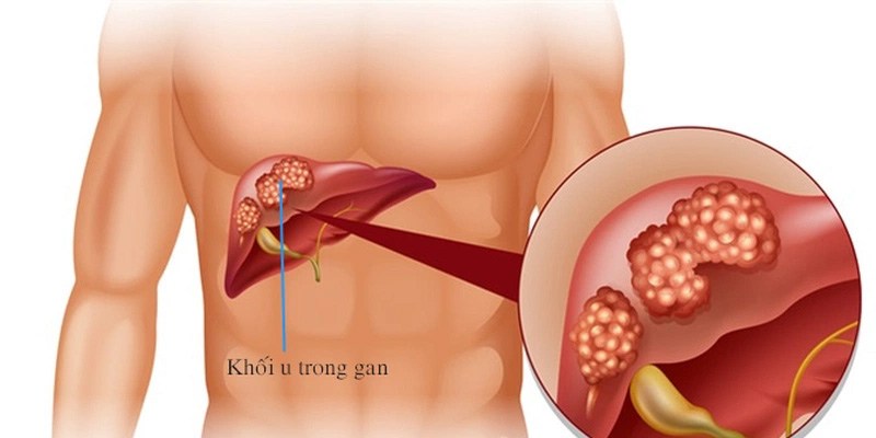 Ung thư gan là biến chứng của xơ gan