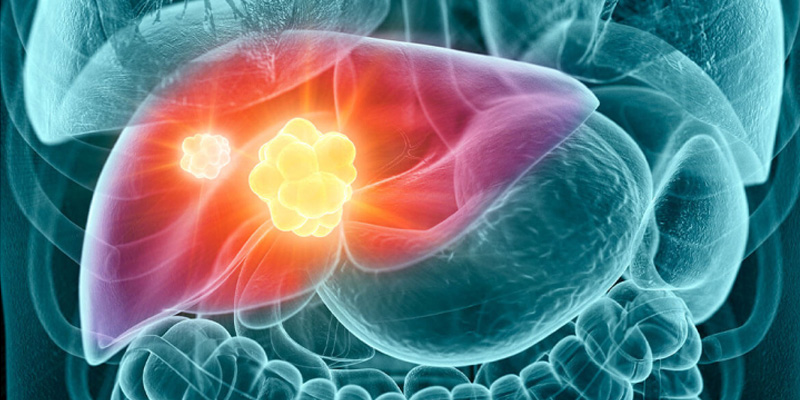 Ung thư gan là sự phát triển quá mức của các tế bào ác tính trong gan