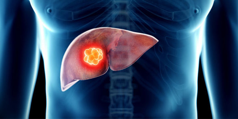 Ung thư nguyên bào gan ở trẻ em là một loại khối u hiếm gặp