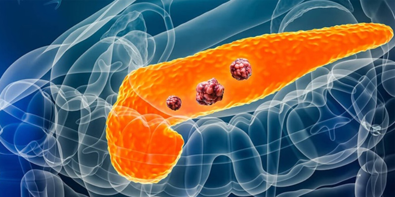 Ung thư tuyến tụy di căn là một trong các loại ung thư có tiên lượng xấu nhất.