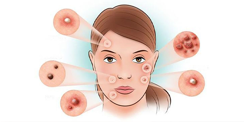 Theo dõi mức độ và diễn biến của mụn