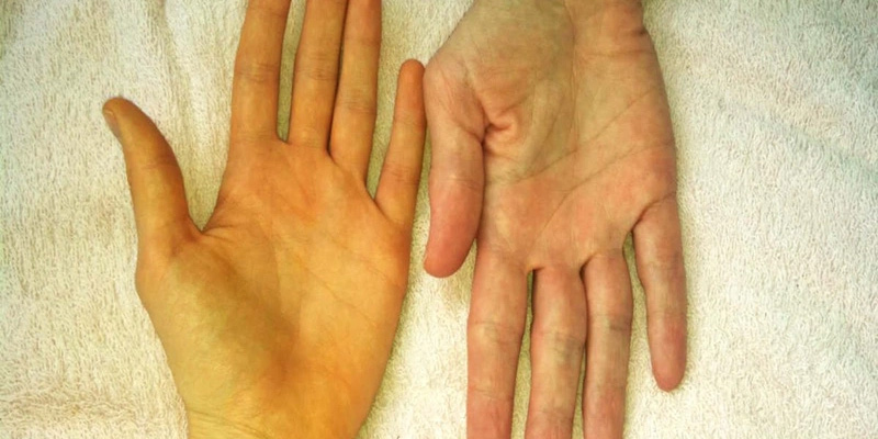 Vàng da là dấu hiệu nhận biết xơ gan cổ trướng giai đoạn cuối