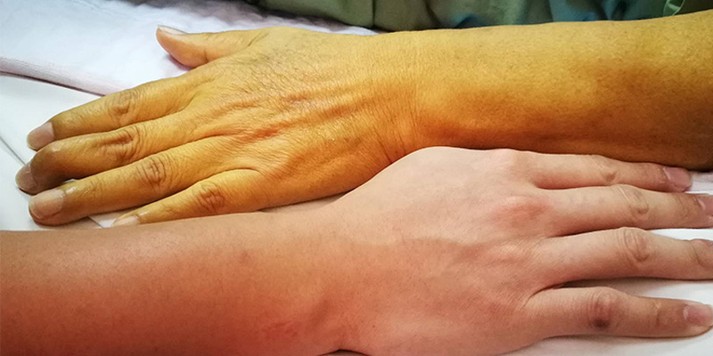 Vàng da là triệu chứng xơ gan đi kèm