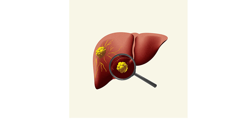 Viêm gan B cấp tính là giai đoạn đầu tiên sau khi cơ thể bị nhiễm virus viêm gan B (HBV)
