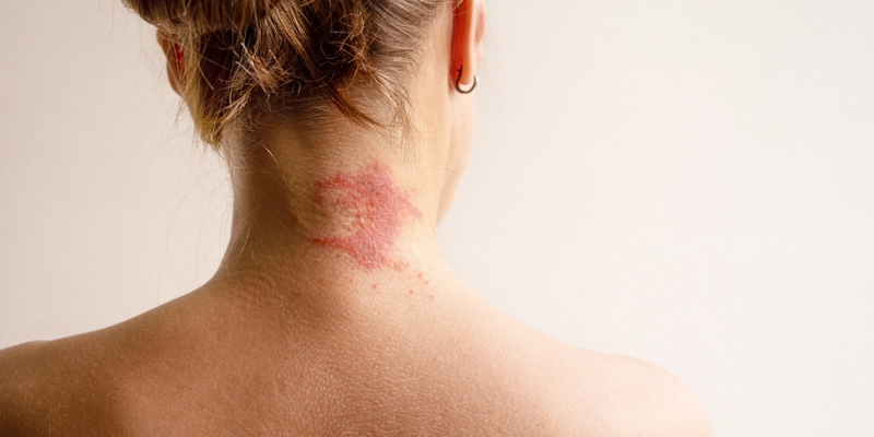 Sinh hoạt thiếu không lành mạnh sẽ khiến bệnh nhân viêm gan B bị ngứa