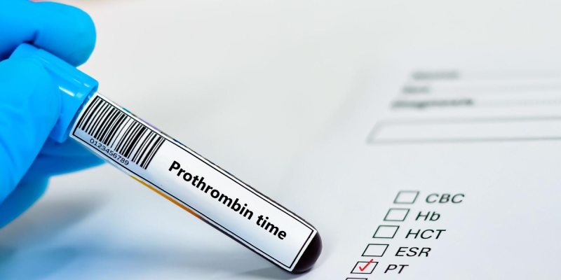 Trước khi nhổ răng, bác sĩ cần đánh giá thời gian prothrombin (PT) và chỉ số INR để đảm bảo an toàn cho người bệnh.