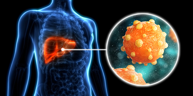 Viêm gan B là bệnh do virus viêm gan B (HBV) gây ra