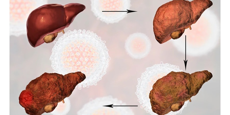 Trạng thái tái hoạt động của virus diễn ra trong âm thầm và lâu dài có thể dẫn đến viêm gan mạn tính, xơ gan nếu không được phát hiện