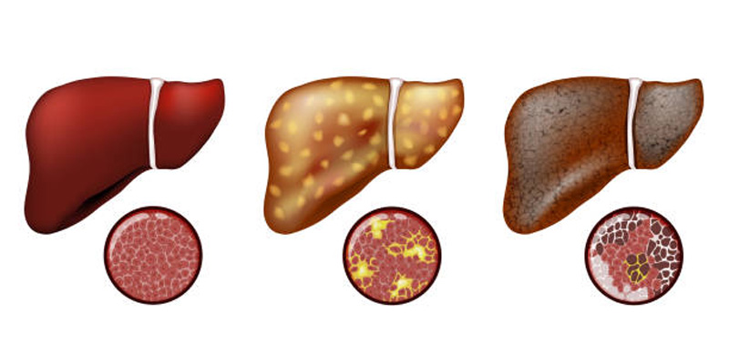 Viêm gan B mạn tính có thể biến chứng thành xơ gan, suy gan, thậm chí ung thư gan