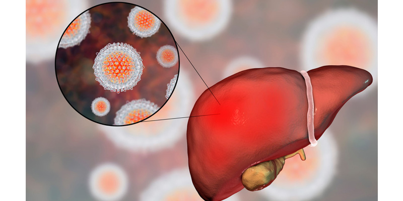 Viêm gan C là một bệnh lý về gan do virus Hepatitis C (HCV) gây ra