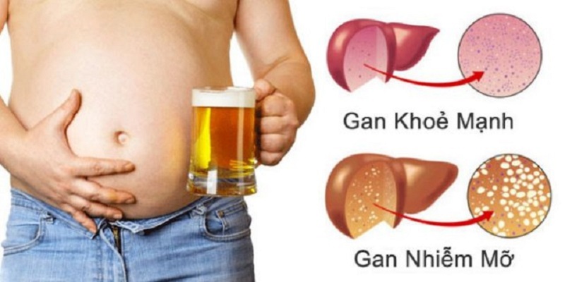 Viêm gan do rượu bia