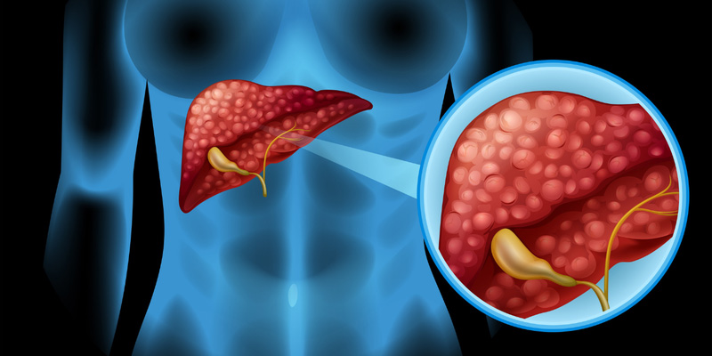 Xơ gan là biến chứng thường gặp của bệnh viêm gan B