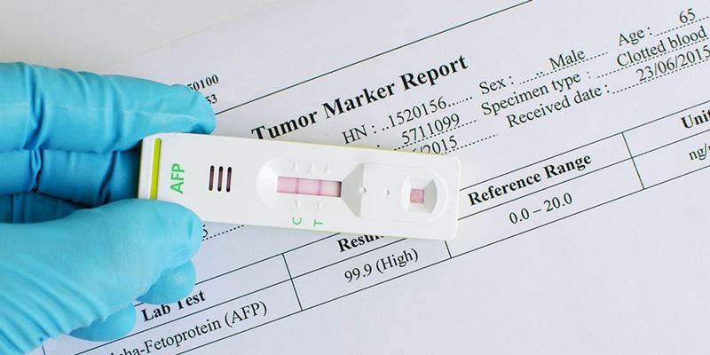 Khi tầm soát ung thư gan và phát hiện chỉ số AFP-L3 cao hơn 10%, bệnh nhân có khả năng cao mắc bệnh ung thư gan.