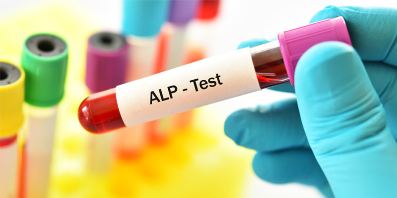 Chỉ số ALP tăng trong xét nghiệm gan nhiễm mỡ