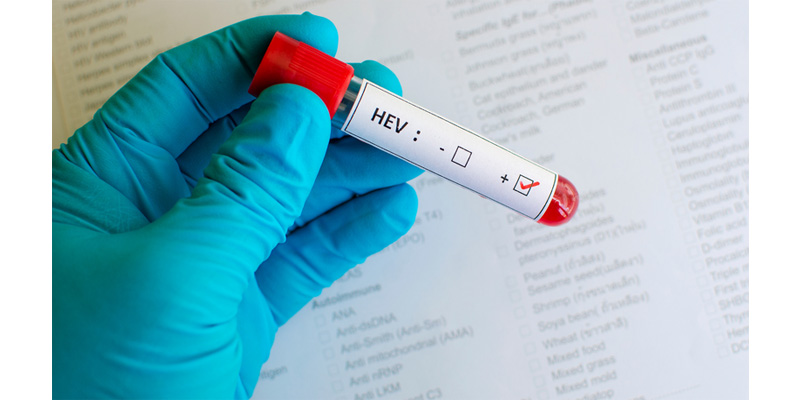 Xét nghiệm kháng thể kháng virus HEV trong máu