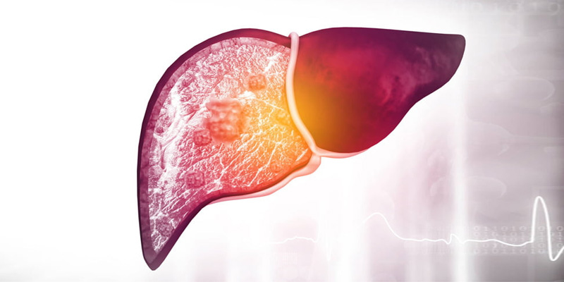 Viêm gan B là một tình trạng bệnh có thể dẫn đến ung thư gan