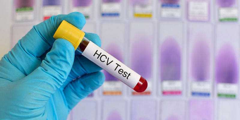 Xét nghiệm viêm gan C khi chưa có triệu chứng