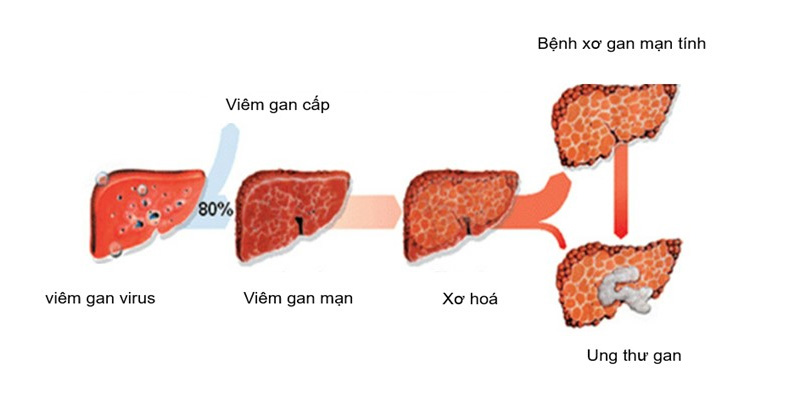 Viêm gan C tiến triển rất âm thầm nên khó để nhận biết