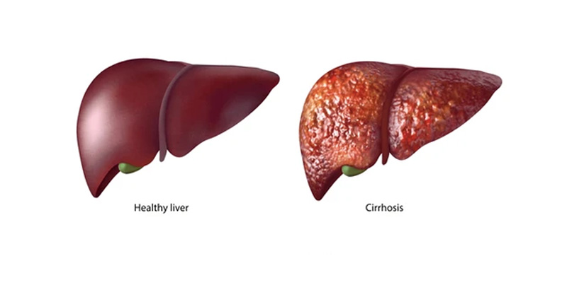 Khi mô sẹo thay thế cho mô gan bình thường gây xơ gan
