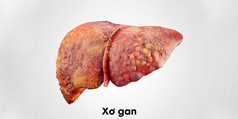 Gan bị mô sẹo phủ khắp khiến giảm chức năng hoạt động