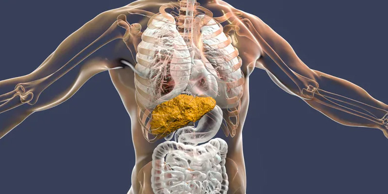 Xơ gan do virus là một trong những nguyên nhân gây ra xơ gan