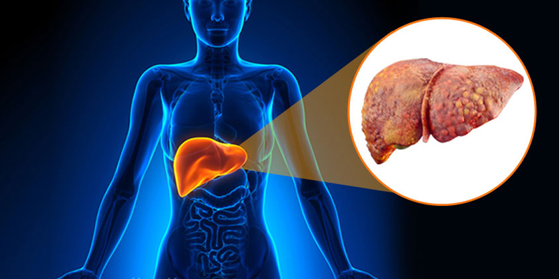 Xơ gan cổ trướng hay còn gọi là xơ gan mất bù