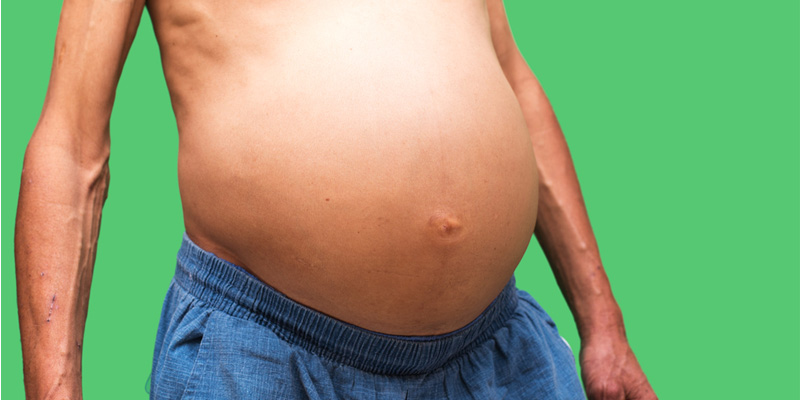 Người mắc bệnh xơ gan cổ trướng sống được bao lâu