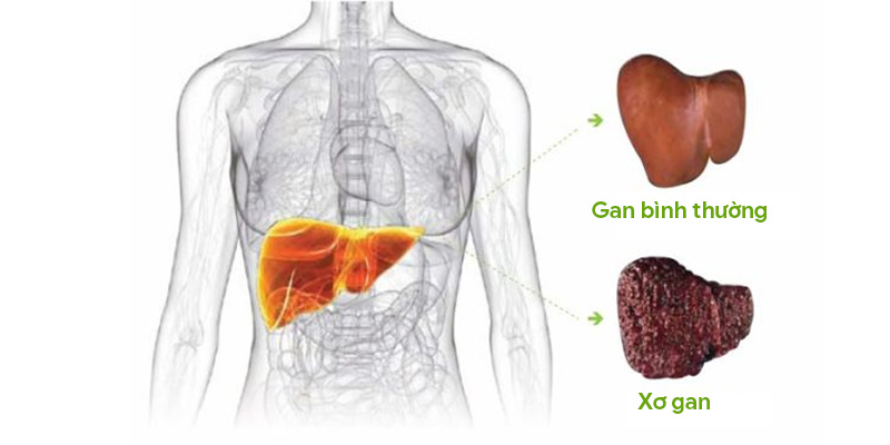 Xơ gan sẽ làm ảnh hưởng nghiêm trọng với sức khỏe