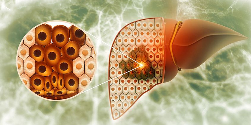 Ở mức độ xơ gan còn bù, các tế bào gan khỏe mạnh còn có khả năng gánh vác lại cho các tế bào bị tổn thương