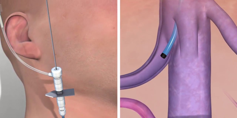 Phương pháp sinh thiết gan qua ngã cảnh