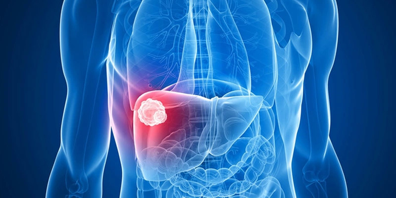 Ung thư gan là biến chứng nguy hiểm nhất của bệnh xơ gan độ 3 (F3)