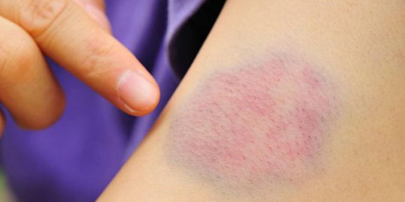 Vết bầm trên da là một trong những dấu hiệu của xơ gan độ 3