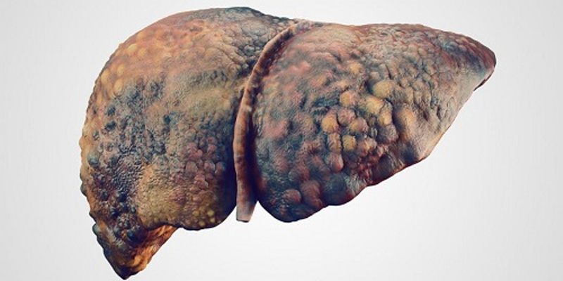 Xơ gan giai đoạn 4 là xơ gan giai đoạn cuối là bệnh lý rất nguy hiểm