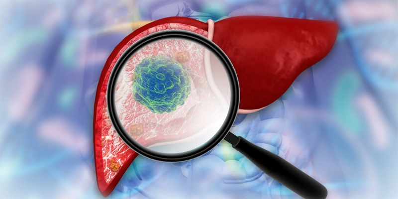 Mô sẹo phát triển làm mất chức năng gan